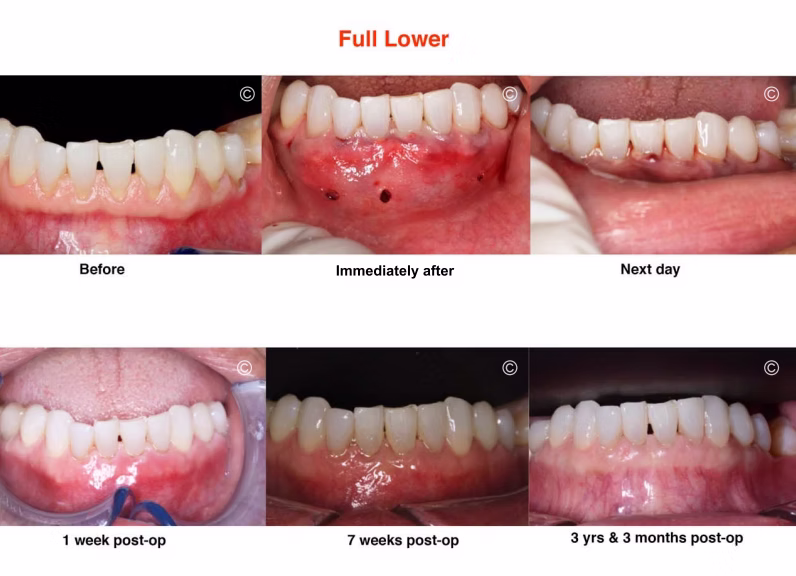 Pinhole vs traditional grafting results